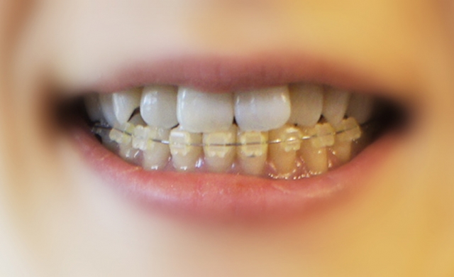 秩父の歯医者が解説！歯周病と糖尿病の意外な関係について