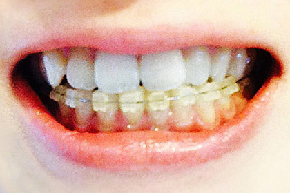秩父の歯医者、ウニクス秩父歯科が行う矯正歯科について（矯正歯科をお考えの方におすすめです）